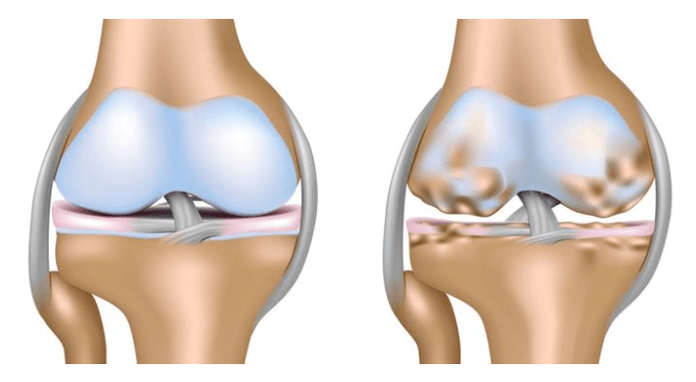 υγιής χόνδρος και βλάβη στην άρθρωση του γόνατος στην οστεοαρθρίτιδα