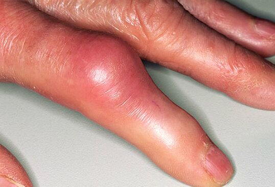 Η ουρική αρθρίτιδα συνοδεύεται από έντονο πόνο στα δάχτυλα και πρήξιμο των αρθρώσεων. 