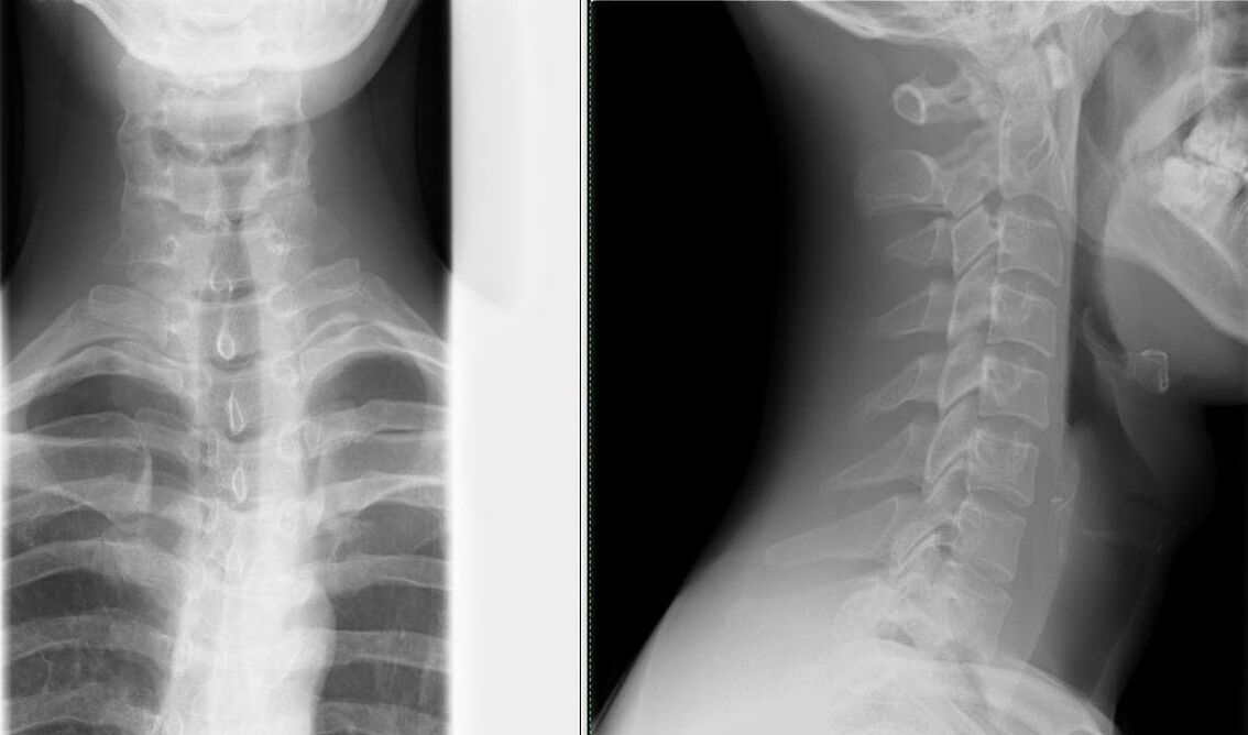 Η ακτινογραφία της σπονδυλικής στήλης είναι μια απλή και αποτελεσματική μέθοδος για τη διάγνωση της οστεοχόνδρωσης